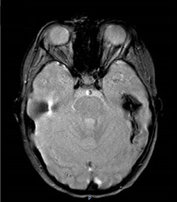 Vasculitis and vasculopathy associated with inborn errors of immunity: an overview